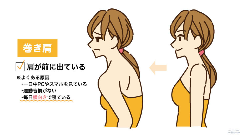 反り腰の影響で仰向けに寝られず横向きで寝ることで、下になった肩に体重がかかり、巻き肩が固定されて肩の痛みにつながる流れを示した図解