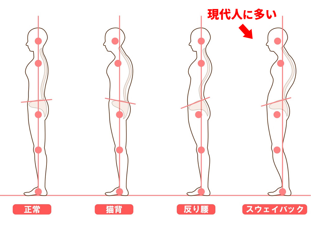 反り腰によって仰向けで寝ると腰がつらくなり、横向きで寝る姿勢が続くことで下になった肩に体重がかかり、巻き肩が固定されて肩の痛みにつながる流れを示した図解